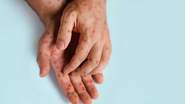 Entidades de México con casos de viruela del mono confirmados