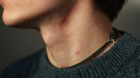 Peligro chupetones en el cuello 