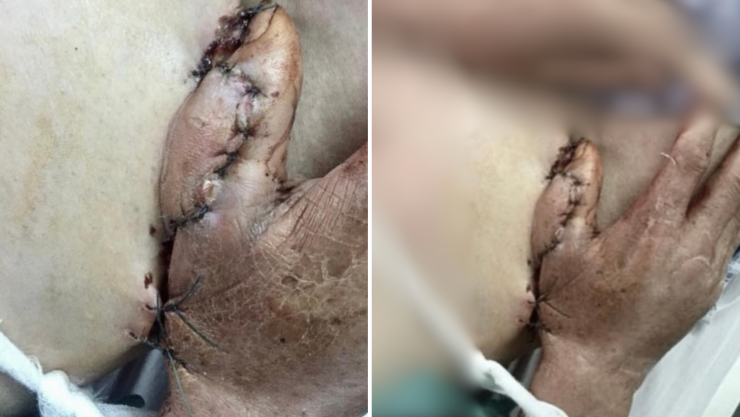 Hombre salva su mano tras accidente y colgajo abdominal, cirugía innovadora.png