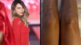 belinda heridas caida.jpg