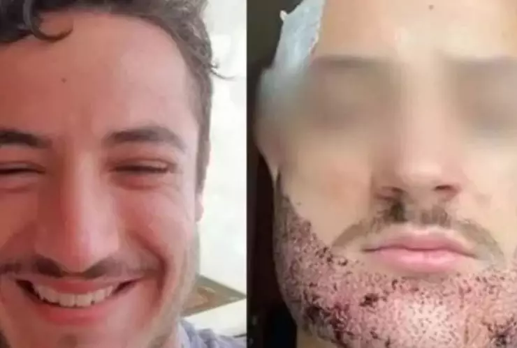 trasplante de barba fallido