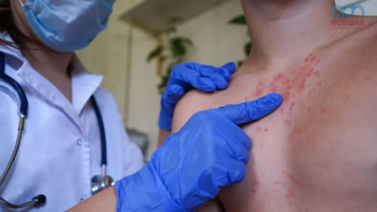 Casos de sarampión en CDMX: Detectan cinco nuevos casos