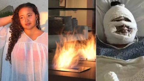 Mujer se desfigura la cara por quemar malvaviscos en California