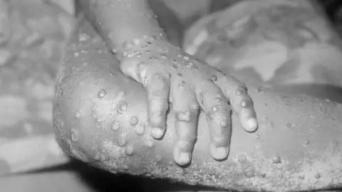 Nueva variante de mpox_ LA OPS pide reforzar vigilancia ante la posible propagación del virus