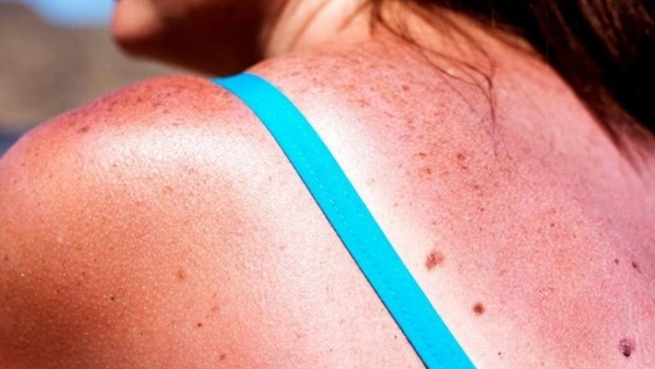 ¡Cuidado! Rayos UV en Yucatán serán PELIGROSOS para la piel HOY viernes 3 de julio