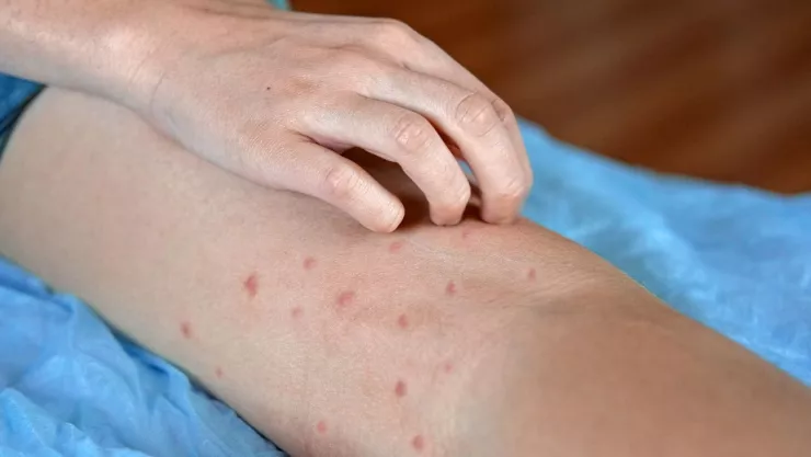 Yucatán reporta aumento de casos de sarampión