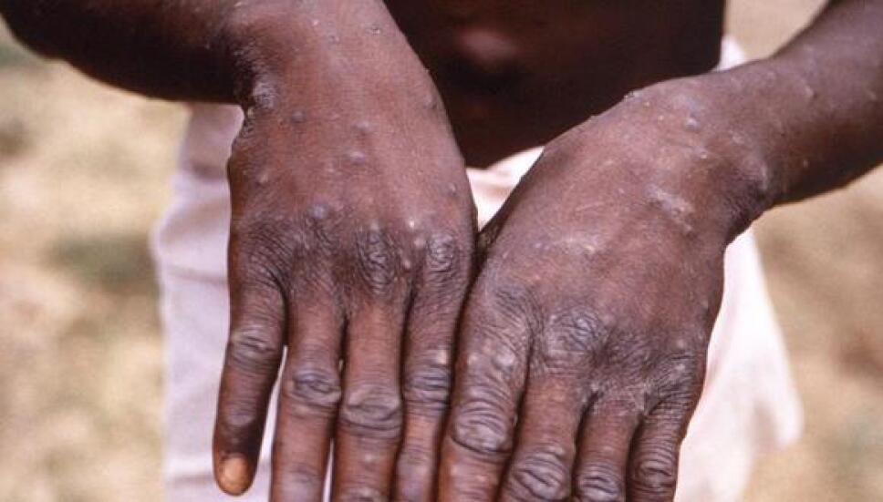 OMS pide cambiar el nombre de la viruela del mono por discriminación