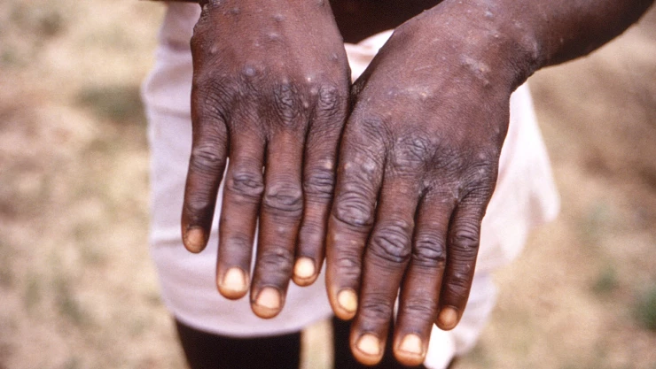 ¿La viruela del mono es una enfermedad de transmisión sexual?