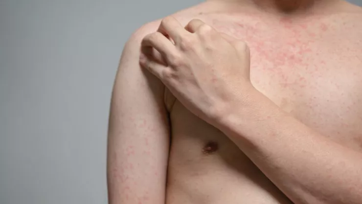 Casos de sarampion en CDMX