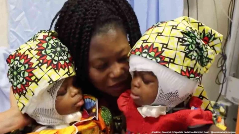 separación siamesas hospital roma .jpg