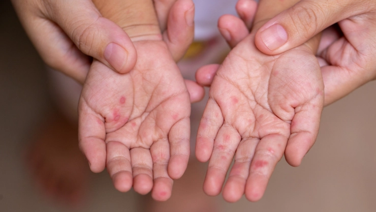 Las manos de un niño con signos de sarampión.