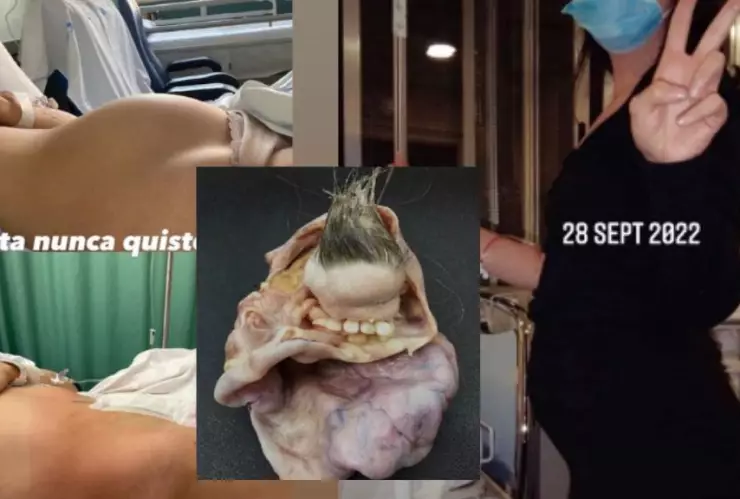 Le salió un teratoma y pensaba que estaba embarazada