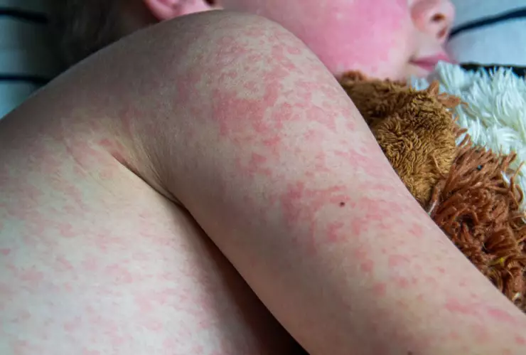 Sarampión en México: la Secretaría de Salud comparte aviso epidemiológico