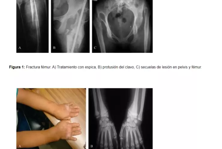 Insensibilidad-congénita-al-dolor