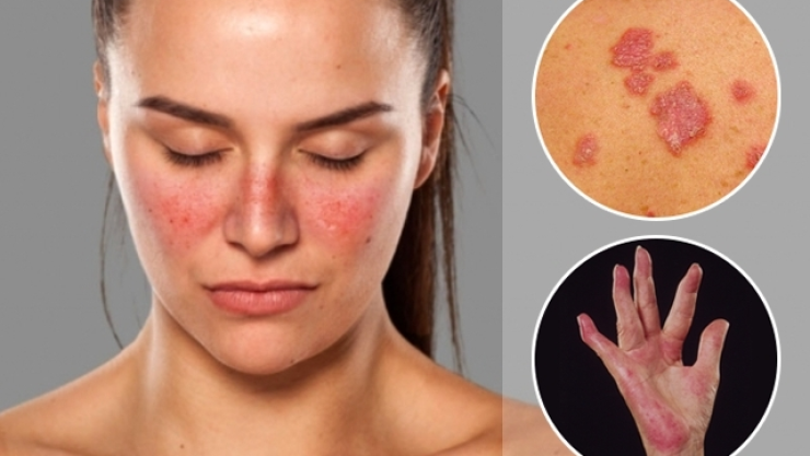 lupus