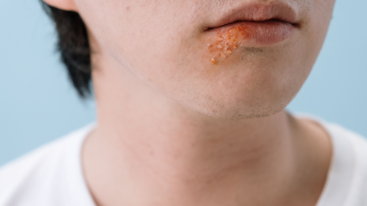 herpes.png