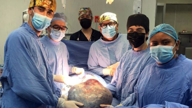 Retiran tumor ovárico de 21 kilos a paciente del IMSS en León, Guanajuato.