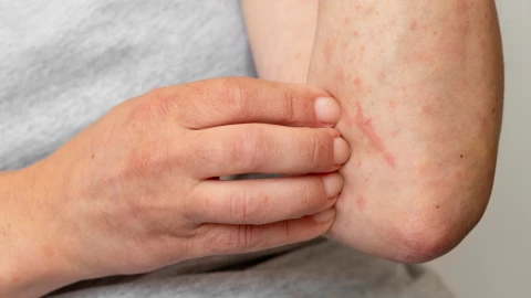 Viruela del mono en Puebla