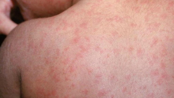 Reportan aumento de casos de sarampión y tosferina en México; ya hay muertos.jpg