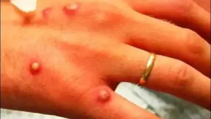 Viruela del mono Edomex