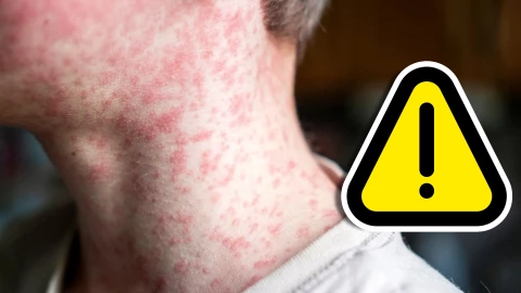 Casos de sarampión en México se acercan a los 3 mil; Chihuahua encabeza cifras.jpg