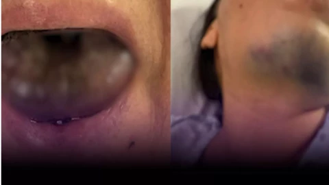 Mujer amanece con la lengua negra en Veracruz