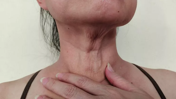 ¿Cómo hacer para que se caiga una verruga? La planta que te ayudará