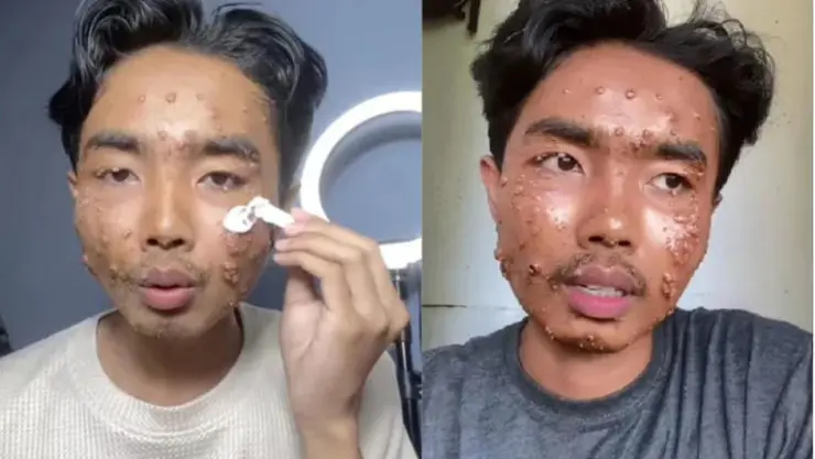 Influencer contrae una infección en la piel tras usar ropa de segunda mano; se trata de molusco contagioso