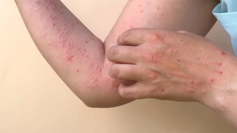 Una persona se rasca ronchas de mpox