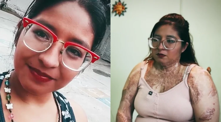 “Me estaba quemando viva”: La lucha de Arely Escobar tras sobrevivir a un intento de feminicidio de su expareja en Chimalhuacán, Edomex
