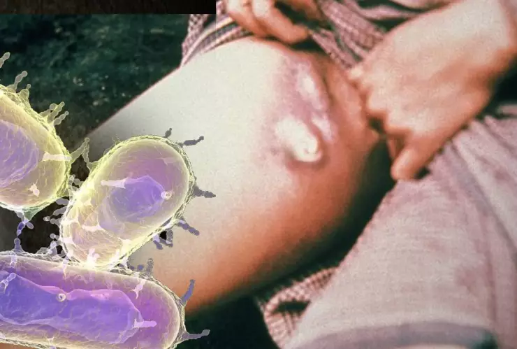 Muere hombre por Peste Bubónica en Estados Unidos; primer caso fatal en años (1).jpg