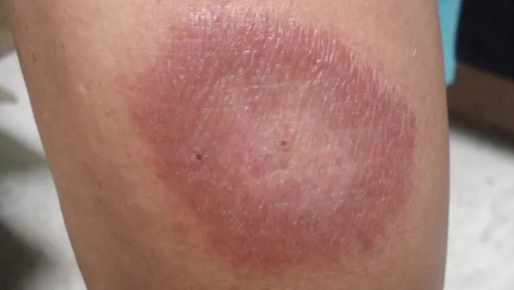 Registran nuevos casos de lepra en M&eacute;xico este 2024, &iquest;qu&eacute; tan peligroso es? 