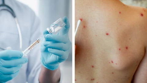 Confirman 28 casos probables de sarampión en Yucatán: qué pasa si no estás vacunado