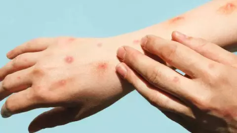 Suben los casos de viruela del mono en Yucatán, van 17 contagios