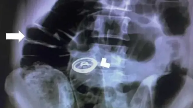 Hombre tenía desodorante atorado en el recto en Irán