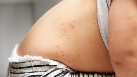 Escarlatina en México: Consulta a un médico en cualquiera de estos seis casos