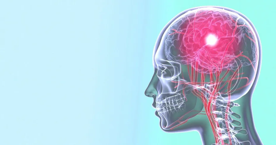 Infarto cerebro vascular Flow unnamed.jpg