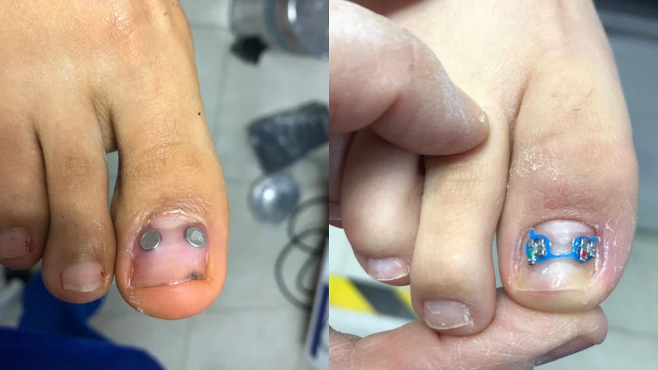 Brackets para los pies