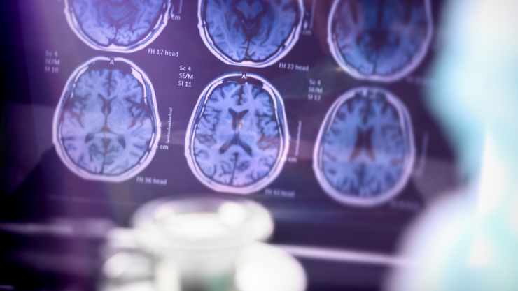 ¿El Alzheimer podría comenzar en la boca?