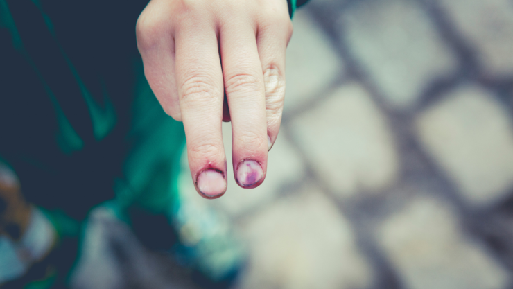 El trucazo casero para quitarse los moretones ocasionados con el deporte de una vez por todas