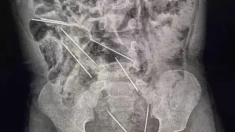 bebe se traga agujas.jpg