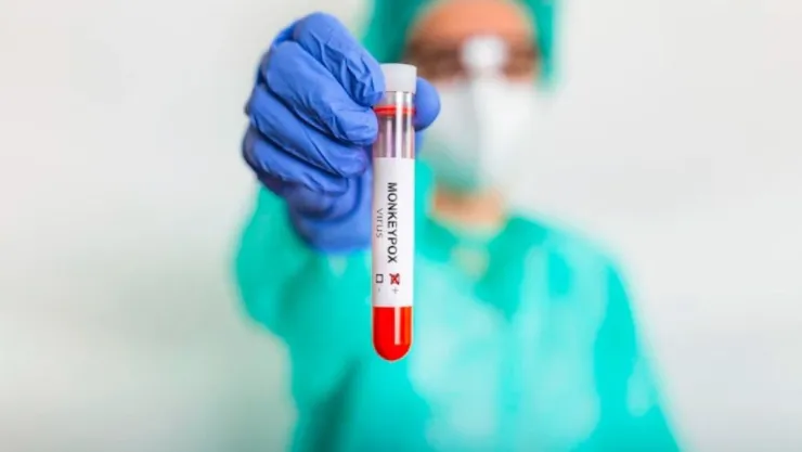 México con 35 casos de viruela de mono hoy 14 de julio 2022.