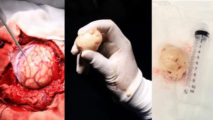 Extirpan tumor cerebral a paciente despierta en el ISSSTE
