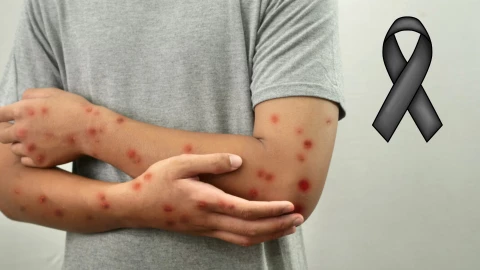 Joven diagnosticado con M-pox PIERDE LA VIDA; es el primer caso mortal en la Península de Yucatán este 2025