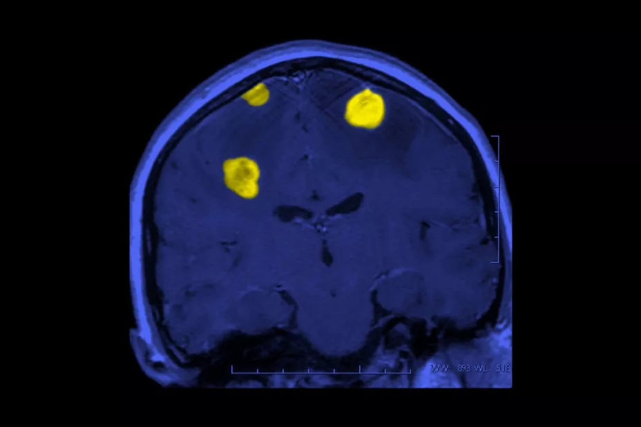 Cáncer cerebro Flow.jpg