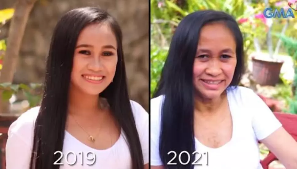 Progeria, joven, anciana.jpg