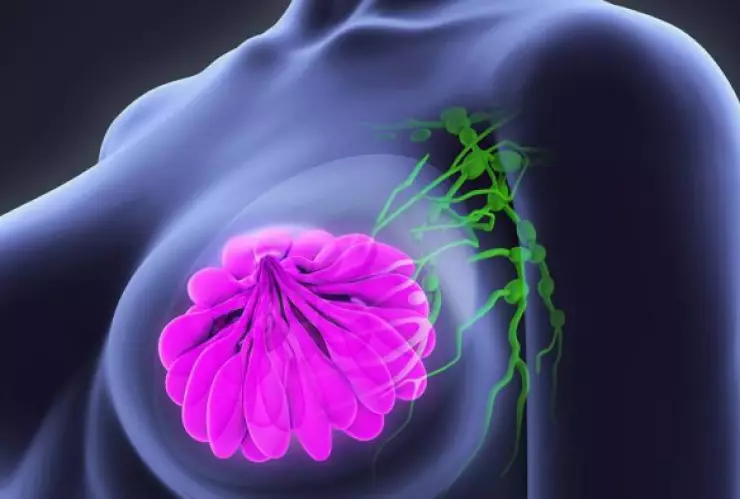 c&aacute;ncer mama.jpg