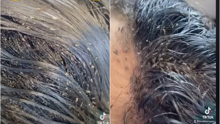 niña piojos TikTok.jpg