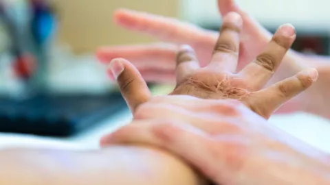 mano de un niño con una quemadura