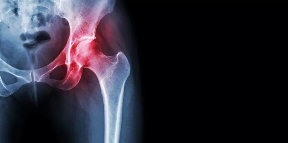 Fractura Cadera Flow unnamed.jpg